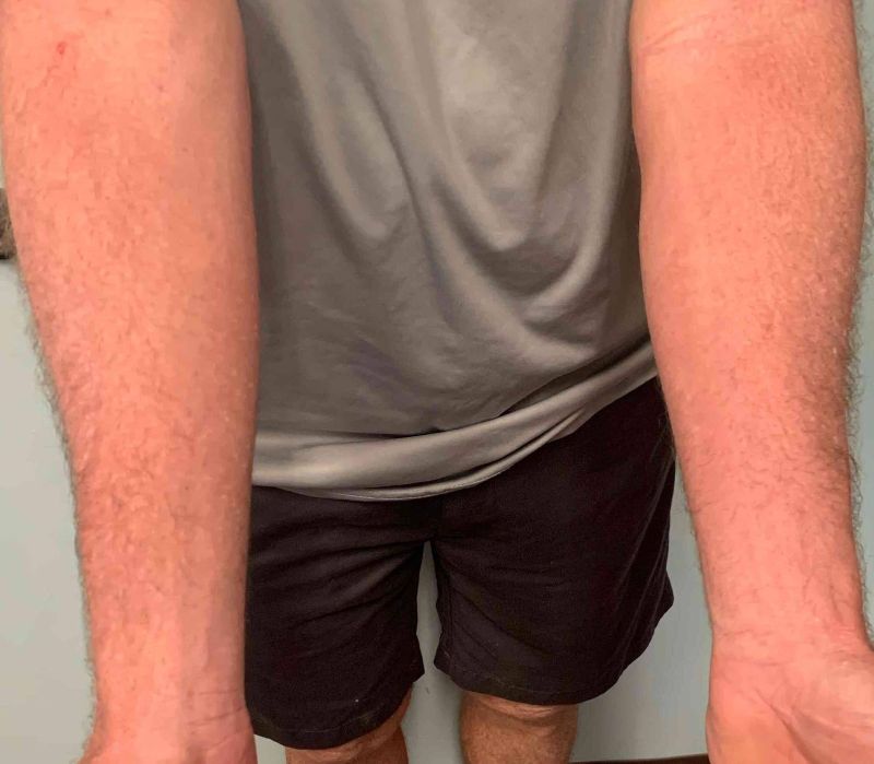 Ekcem na rukama nakon upotrebe kreme za ekcem i psorijazu Hemp Organic