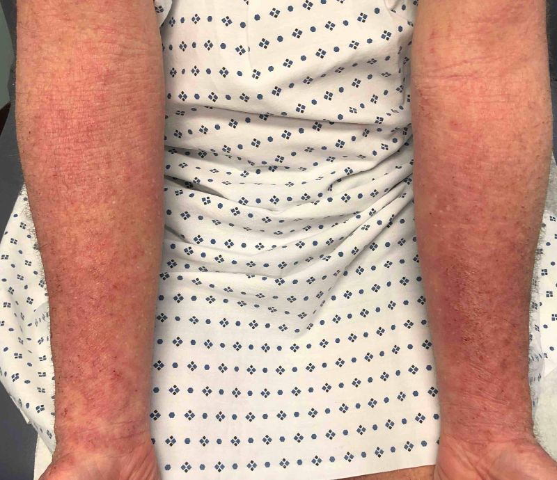 Ekcem na rukama pre upotrebe kreme za ekcem i psorijazu Hemp Organic