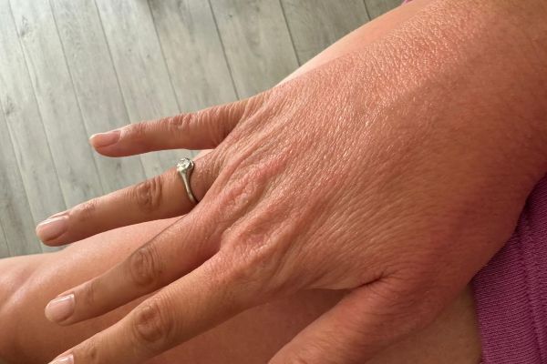 Koža nakon upotrebe kreme za ekcem i psorijazu Hemp Organic