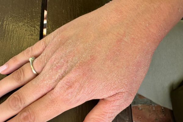 Koža pre upotrebe kreme za ekcem i psorijazu Hemp Organic